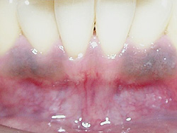 歯肉の漂白-術前